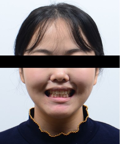 돌출입 · 잇몸웃음 · 발치교정 치료 후 사진