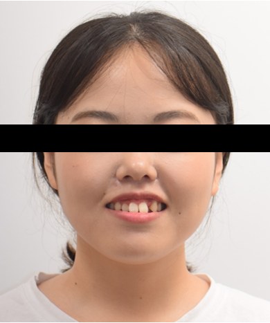 돌출입 · 잇몸웃음 · 발치교정 치료 전 사진