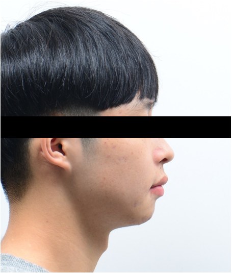 무턱 · 돌출입 · 발치교정 치료 후 사진