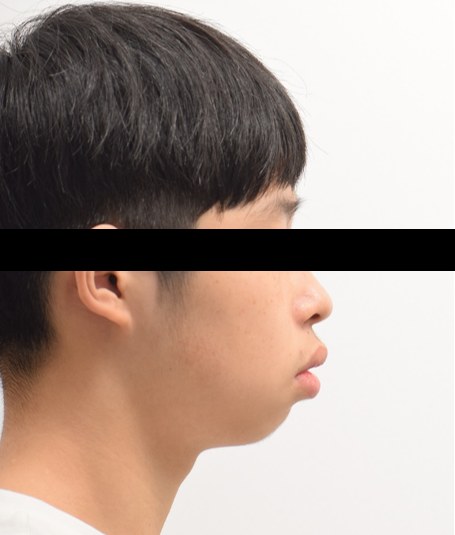 무턱 · 돌출입 · 발치교정 치료 전 사진