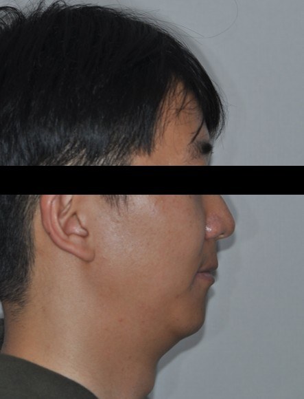 무턱 · 돌출입 · 발치교정 치료 후 사진