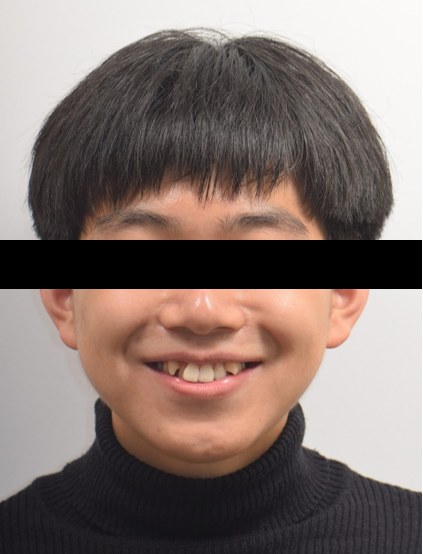 과잉치 · 치외치 동반 삐뚤빼뚤 교정 치료 전 사진