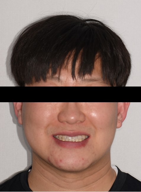 주걱턱 · 반대교합 · 비수술 교정 치료 후 사진