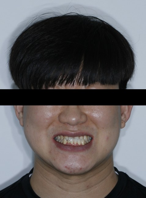 주걱턱 · 반대교합 · 비수술 교정 치료 전 사진