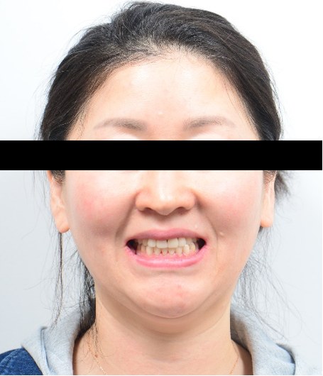 주걱턱 경향 · 절단교합 · 비발치교정 치료 후 사진