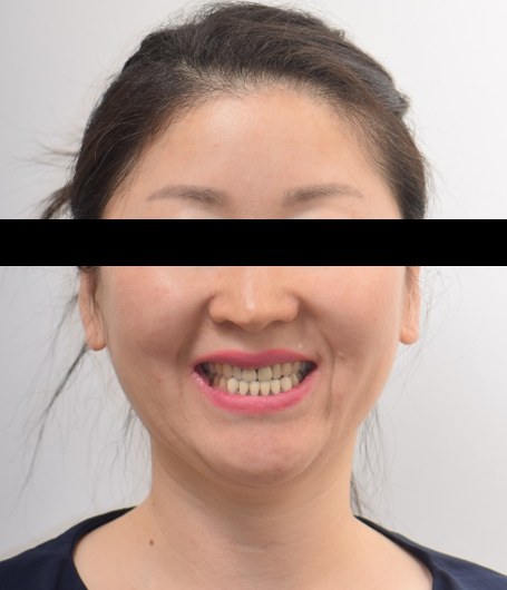 주걱턱 경향 · 절단교합 · 비발치교정 치료 전 사진