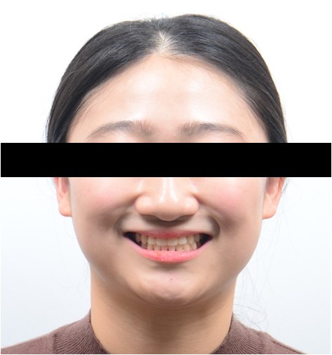 비대칭 · 반대교합 · 비수술 교정 치료 후 사진