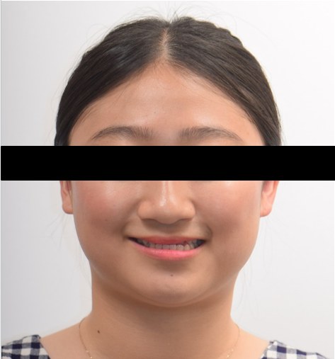 비대칭 · 반대교합 · 비수술 교정 치료 전 사진
