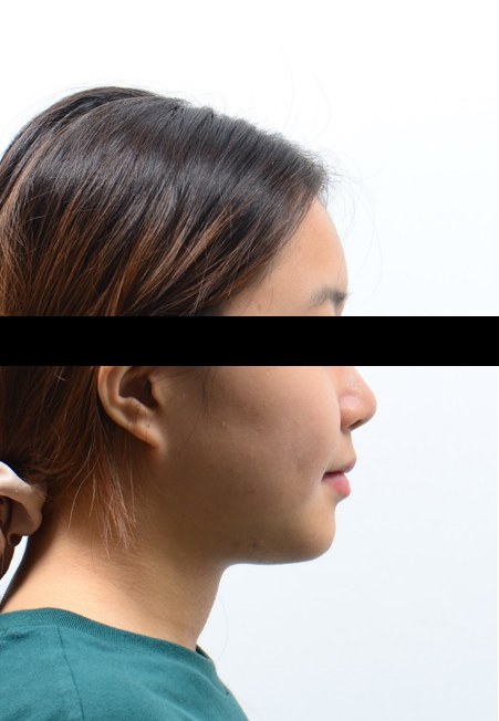 주걱턱 · 양악수술을 위한 교정 치료 후 사진