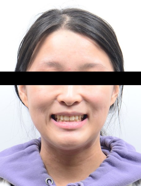 좁은 위턱 확장(MARPE) · 비발치교정 치료 후 사진
