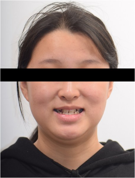 좁은 위턱 확장(MARPE) · 비발치교정 치료 전 사진