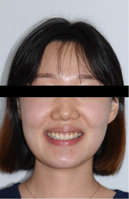 잇몸웃음 · 깊은 교합 · 비발치교정 치료 전 사진
