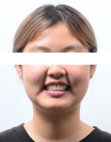 덧니 · 발치교정 치료 후 사진