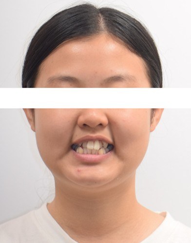 덧니 · 발치교정 치료 전 사진