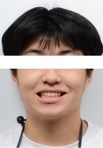 아래 앞니 결손 · 주걱턱 경향 · 비발치교정 치료 후 사진
