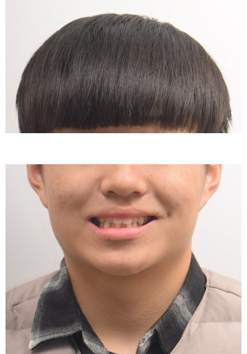 아래 앞니 결손 · 주걱턱 경향 · 비발치교정 치료 전 사진