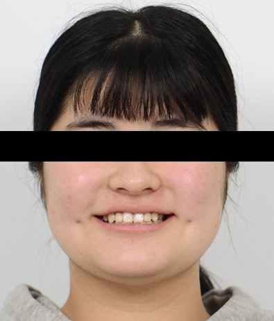 좁은 위턱 확장(MSE) 교정 치료 후 사진
