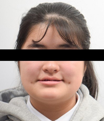 좁은 위턱 확장(MSE) 교정 치료 전 사진