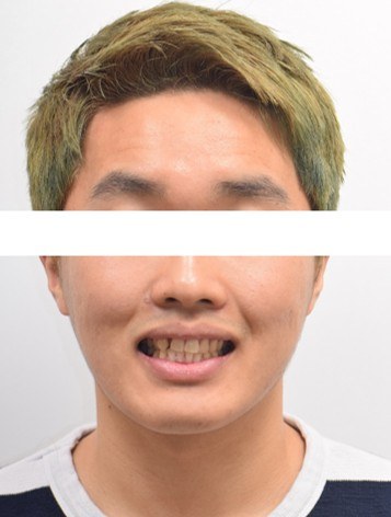위턱 돌출 개선 · 비발치교정(교정용 나사) 치료 전 사진