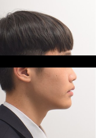 성장기 하악 성장 유도(액티베이터) 치료 후 사진