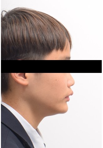 성장기 하악 성장 유도(액티베이터) 치료 전 사진