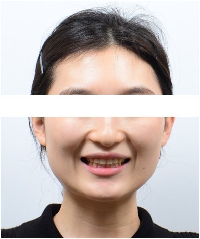 잇몸웃음 · 비발치교정 치료 후 사진
