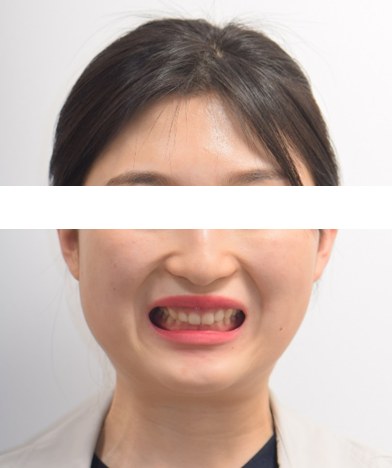 잇몸웃음 · 비발치교정 치료 전 사진