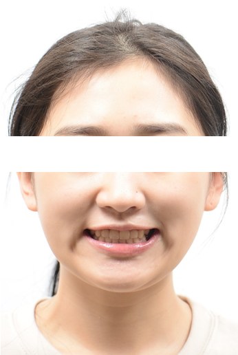좁은 위턱 확장(MSE) · 비발치교정 치료 후 사진
