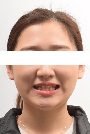 좁은 위턱 확장(MSE) · 비발치교정 치료 전 사진