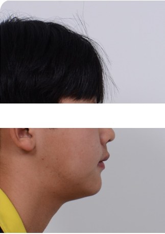 무턱 · 돌출입 · 발치교정 치료 후 사진