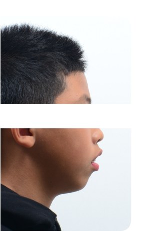 무턱 · 돌출입 · 발치교정 치료 전 사진