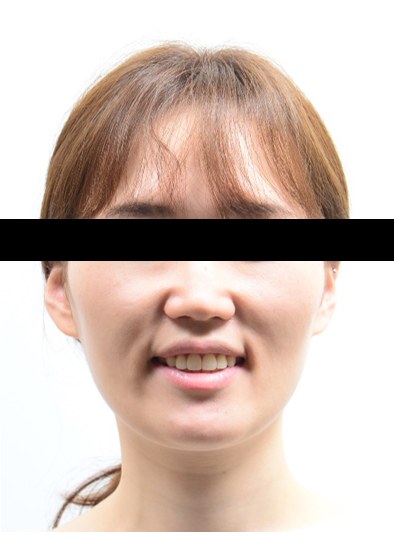 개방교합 · 비발치교정 치료 후 사진