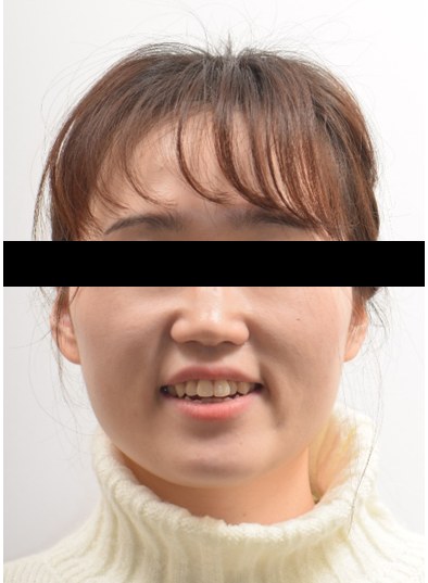 개방교합 · 비발치교정 치료 전 사진