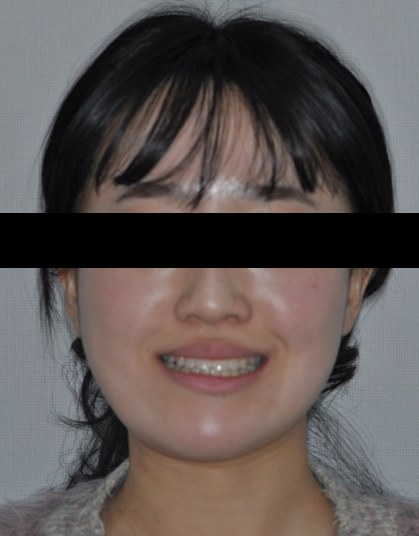 주걱턱 · 비대칭 비수술교정 치료 후 사진