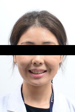 앞니 노출 개선 · 비발치교정 치료 후 사진