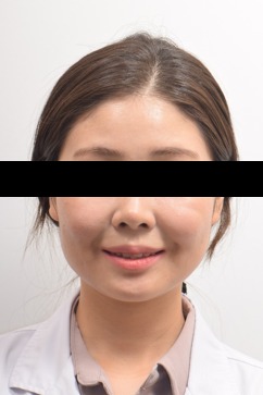 앞니 노출 개선 · 비발치교정 치료 전 사진