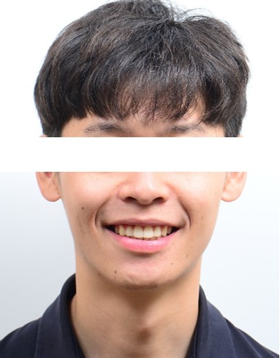 돌출입 · 비발치교정 치료 후 사진