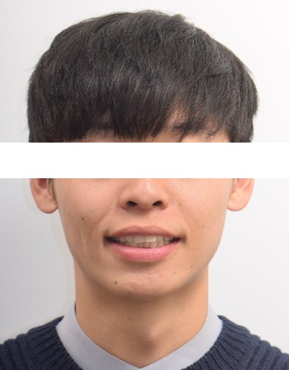 돌출입 · 비발치교정 치료 전 사진