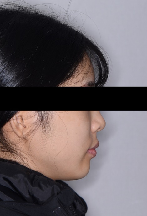 아래 앞니 결손 · 비발치교정 치료 후 사진