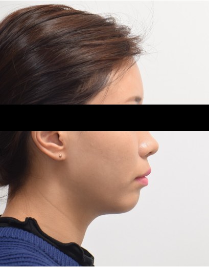 돌출입 · 비발치교정 치료 전 사진