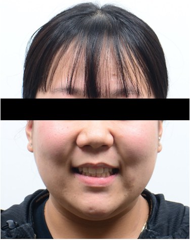 삐뚤빼뚤 · 발치교정 치료 후 사진