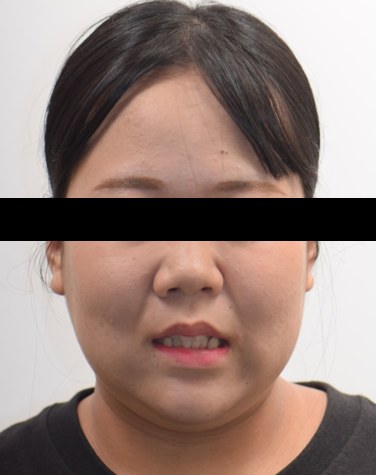 삐뚤빼뚤 · 발치교정 치료 전 사진