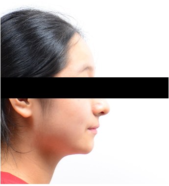 돌출입 · 덧니 · 비발치교정 치료 후 사진