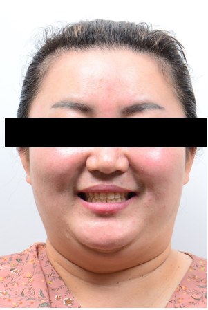 #15 · 25 구개측 변위 개선 치료 후 사진