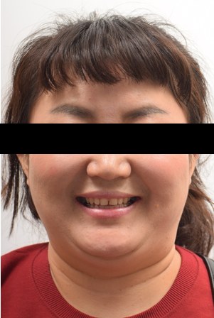 #15 · 25 구개측 변위 개선 치료 전 사진