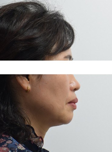 돌출입 · 발치교정 치료 전 사진