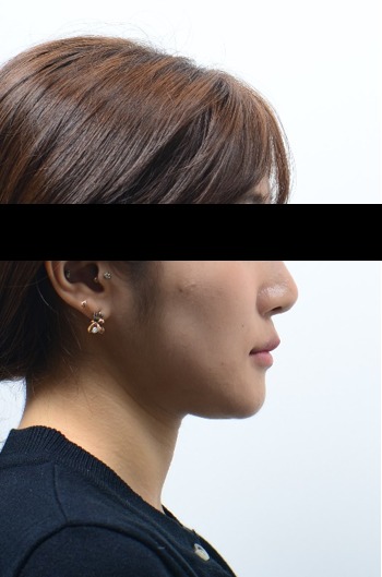 아래턱 수술 동반 교정 치료 후 사진