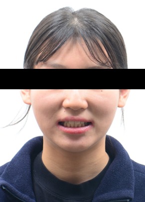 외상 치아 · 송곳니 대체 교정 치료 후 사진