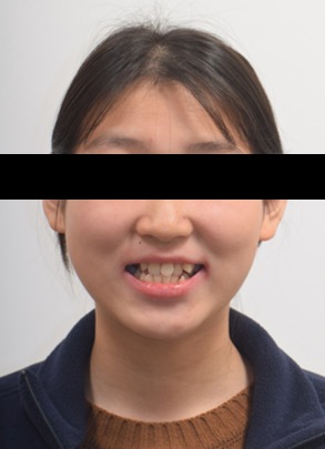 외상 치아 · 송곳니 대체 교정 치료 전 사진