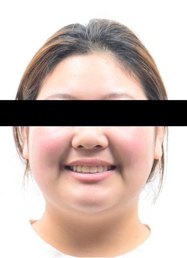 주걱턱 경향 · 비발치교정 치료 후 사진